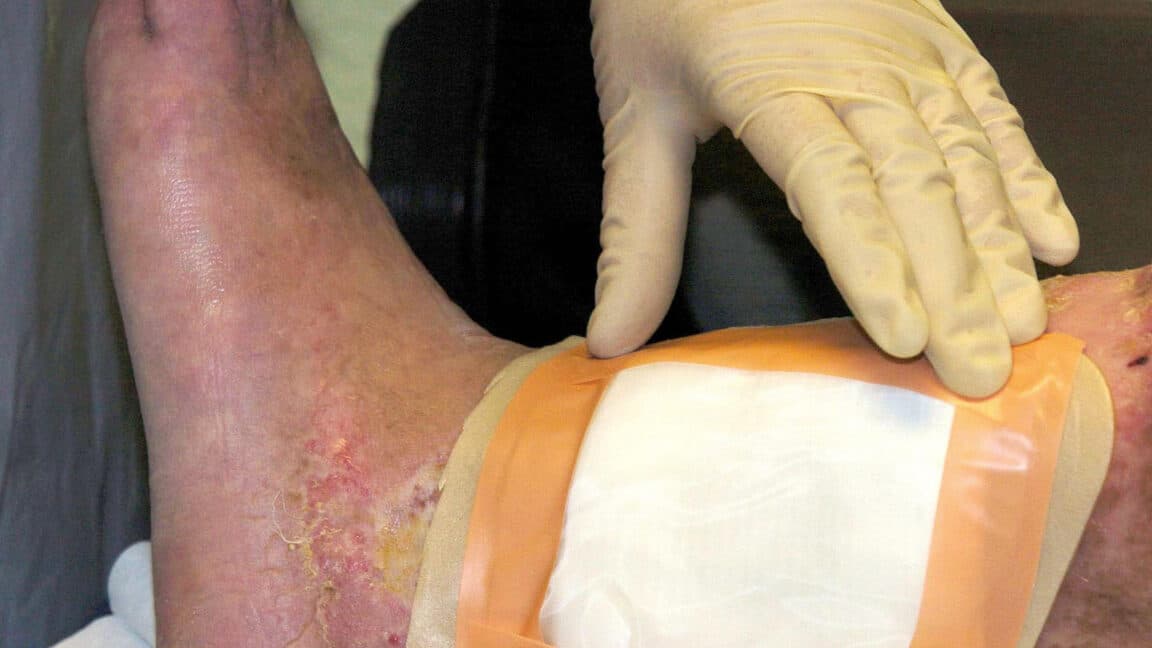 FDA Clears Second Fly Species for Maggot Wound Therapy: What You Need to Know About MediFly Maggots