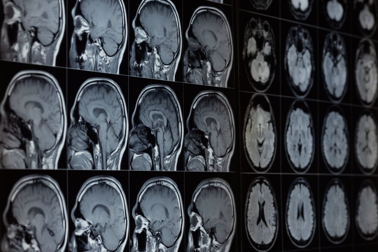 Scientists Put Stroke Patients on Ice—and It Might Protect Their Brains
